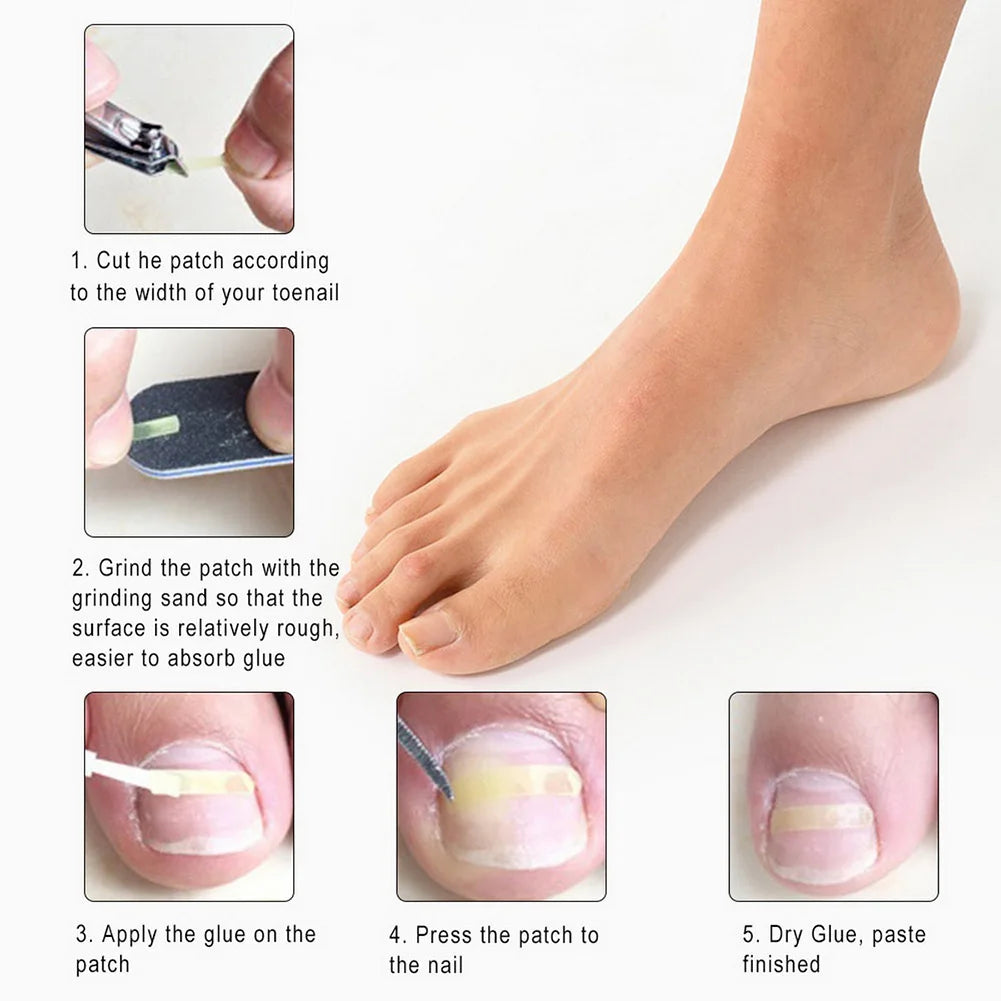 10-100Pcs Ingrown Toe Nail Correction Sticker Patch Paronychia Correction File Acronyx Wire Corrector Foot Care Treatment